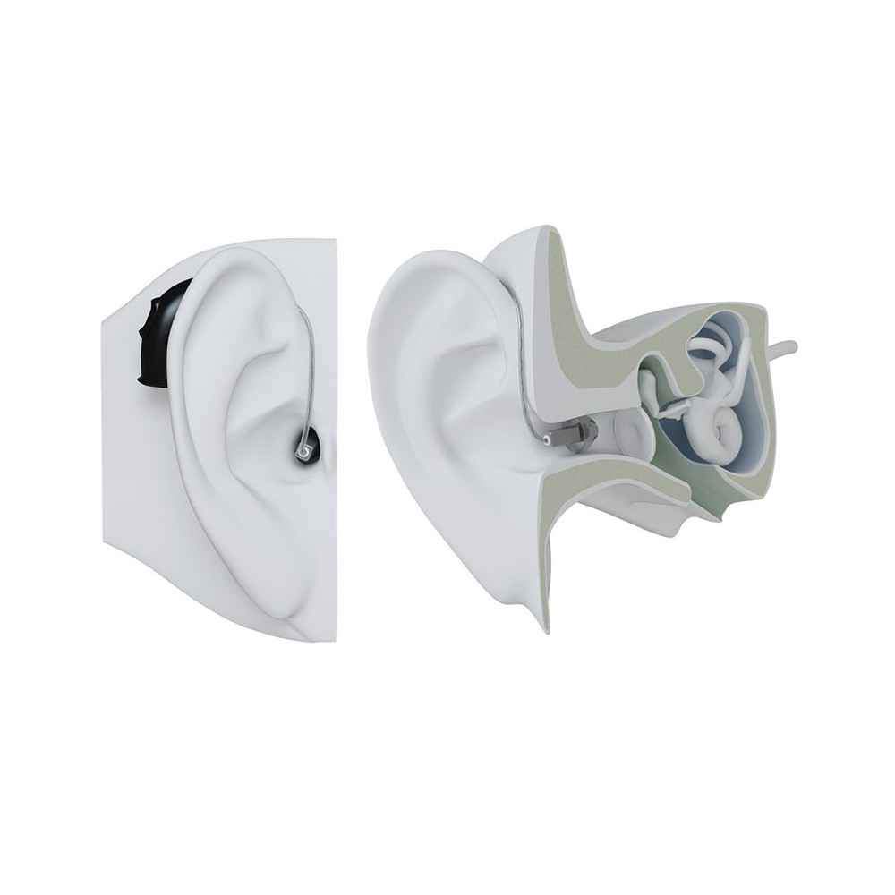 Ακουστικά βαρηκοΐας Resound με δέκτη στο αυτί (Receiver In Ear - RIE) Ακουστικά βαρηκοΐας ψηφιακά Resound