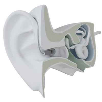 Ακουστικά βαρηκοΐας Resound με δέκτη στο αυτί (Receiver In Ear - RIE) Ακουστικά βαρηκοΐας ψηφιακά Resound