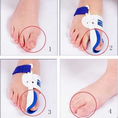Νάρθηκας ανάπαυσης για Hallux Valgus | Ζεύγος Πέλμα